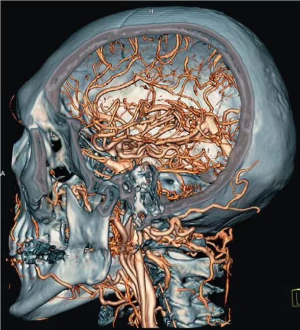 Кт ангиография головного мозга. Ангиограмма сосудов головного мозга. Кт головы москва