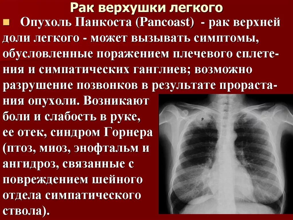 Рак легкого симптомы сколько живут. Опухоль верхушки легкого. Опухоль верхушки правого легкого. Опухоль легких симптомы.