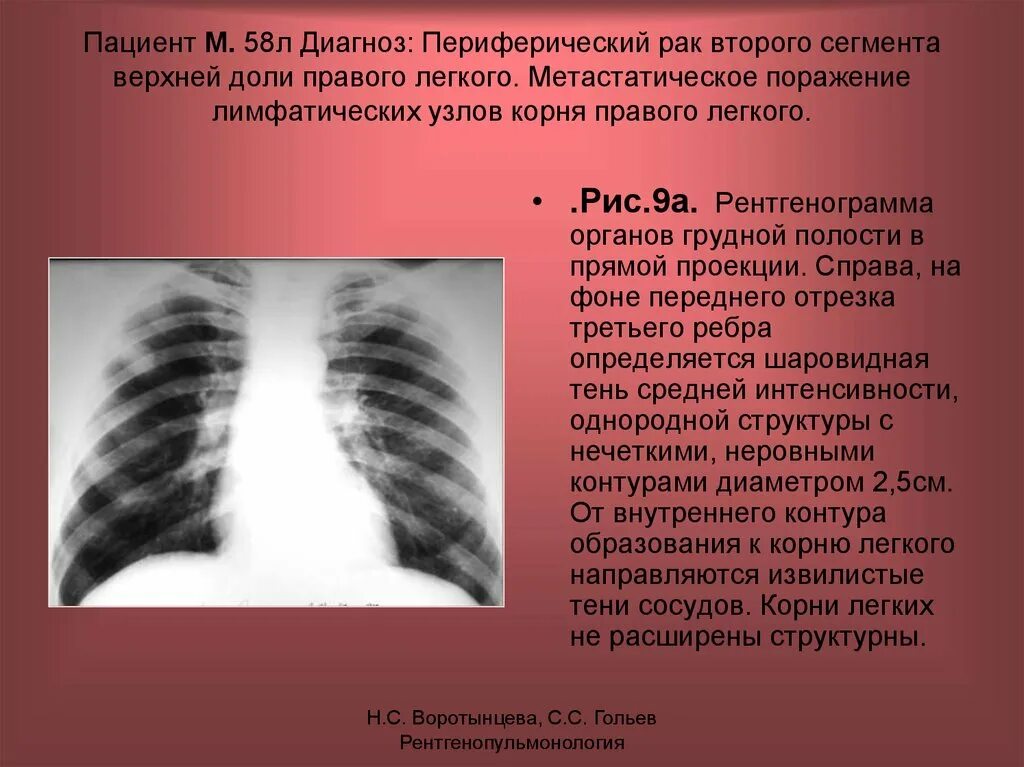 Образование корня легкого. Тень средней интенсивности на рентгенограмме. Образование верхней доли левого легкого. Округлых образования в лёгких. Тень в левом легком