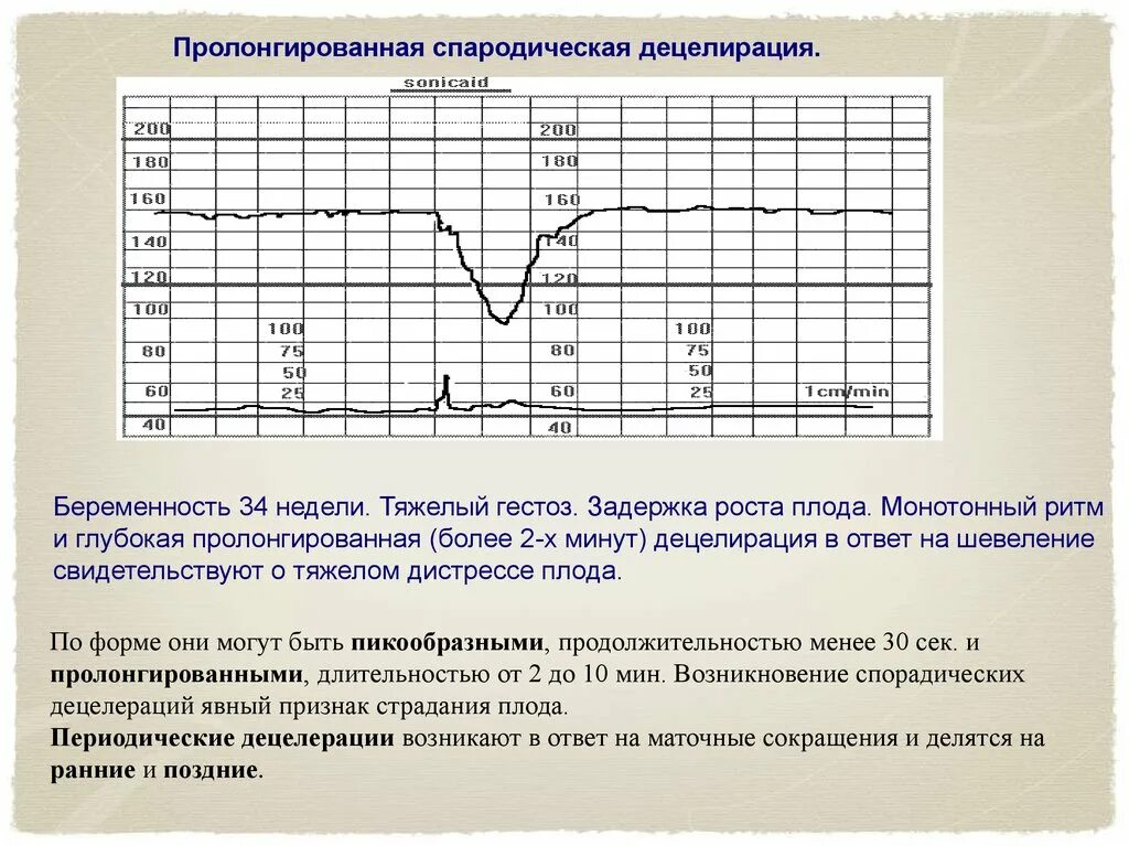 Исследование сердцебиения плода. Нормальная диаграмма КТГ. Патологический Тип Кривой КТГ. Нормальный Тип КТГ плода. КТГ нормальный Тип Кривой.