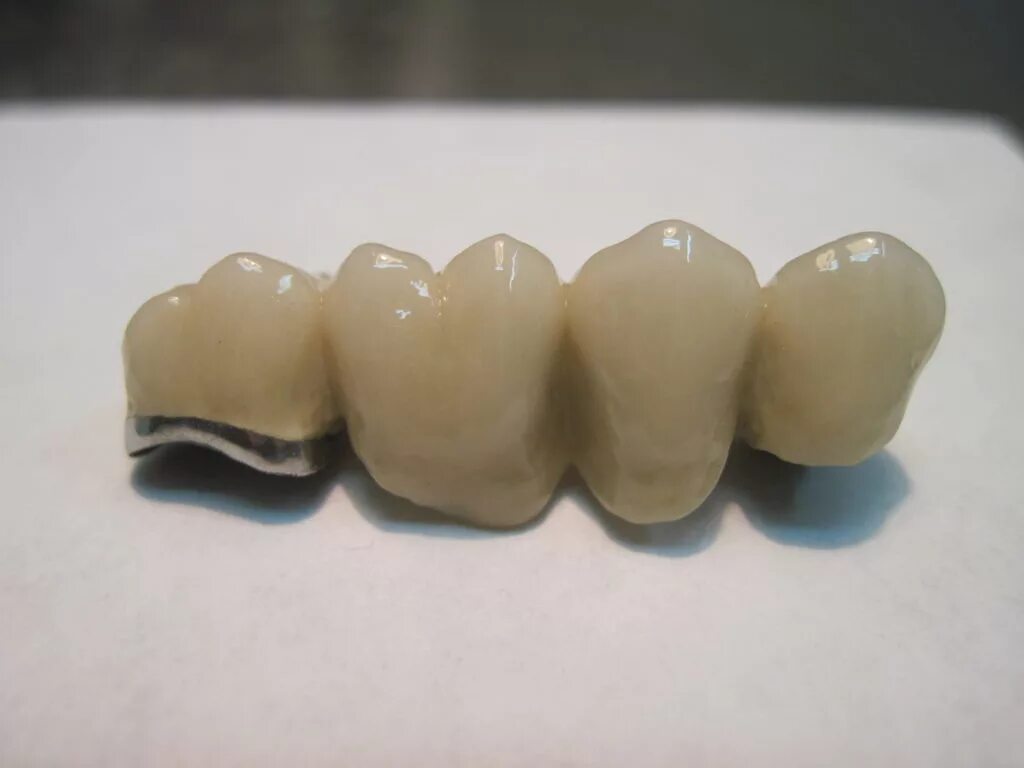 Оксид циркония безметалловая керамика а1. Скол протеза. Скол протеза. Керамометалическая коронка. Диоксид циркония коронки.