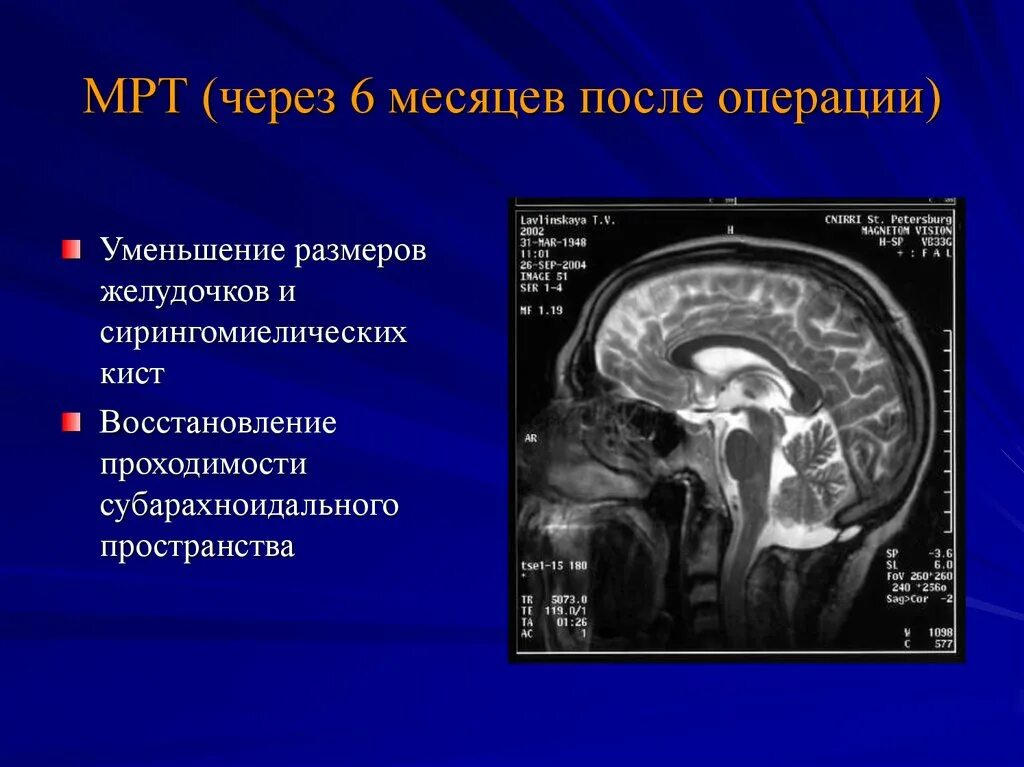 Код мкб арнольда киари