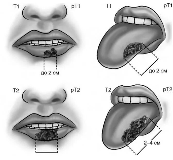 Новообразование на нижней губе. Злокачественное новообразование губы. Губы после сигарет