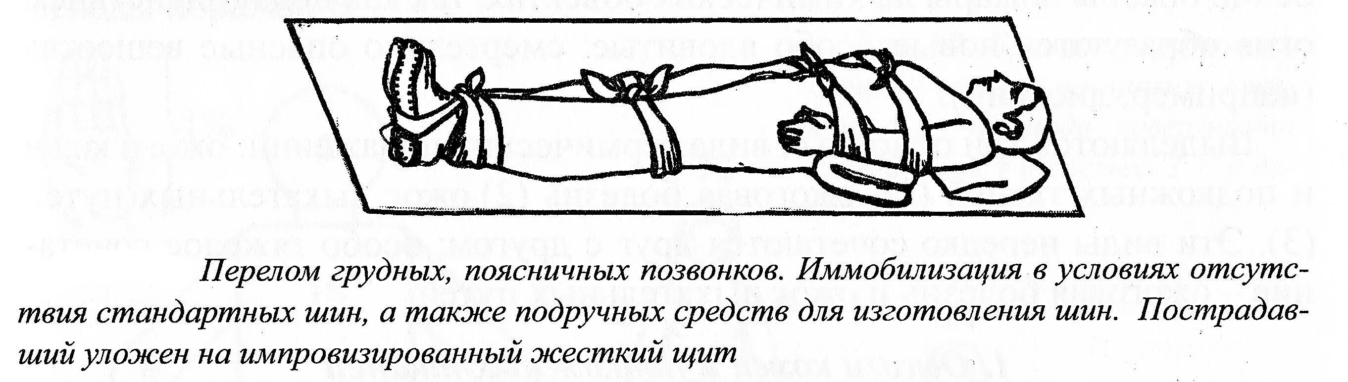 Как транспортировать пострадавшего с повреждением позвоночника. Иммобилизация пострадавшего при переломе позвоночника. Иммобилизация при переломе позвоночника проводится. Положение при переломе позвоночника. Транспортировка больного с переломом позвоночника.