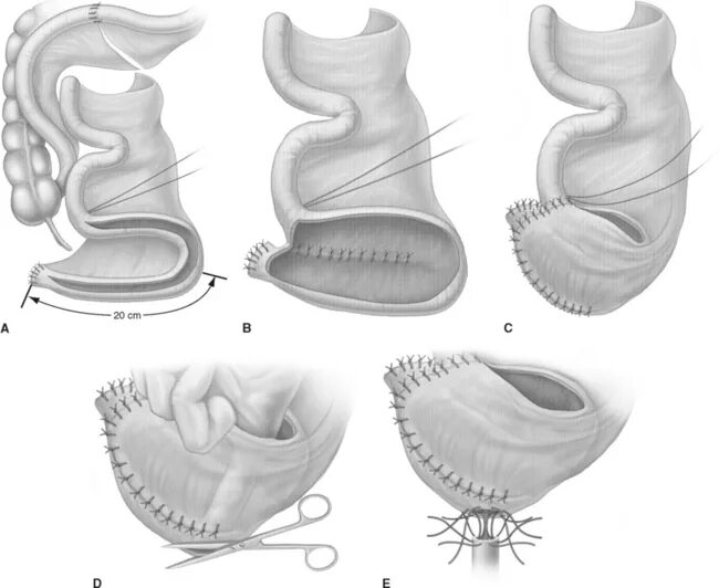 Операция брикера уретероилеокутанеостомия что это. Ортотопическая цистопластика. Цистэктомия операция брикера. Ортотопическая цистопластика. Операция брикера мочевого пузыря.