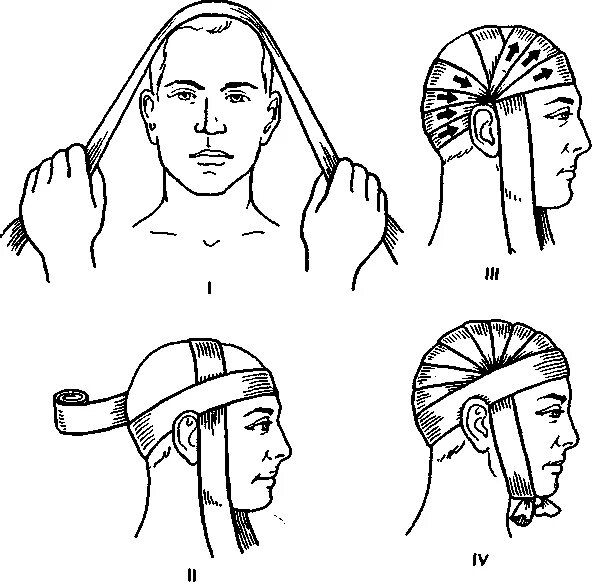 Повязка накладывается при повреждении затылка. Повязка чепец алгоритм. Повязка чепец при ЧМТ. Перевязка головы чепец. Чепец десмургия.
