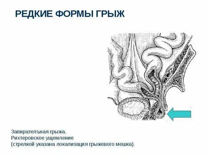 Лечение грыжи живота