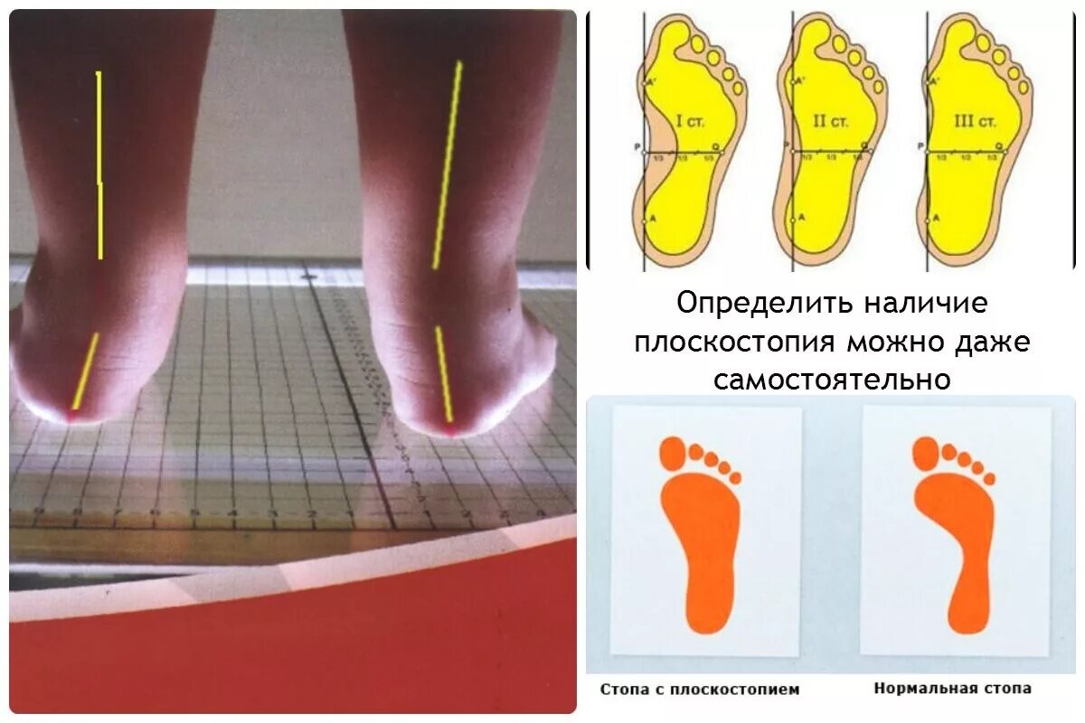 Плоскостопие у детей причины и лечение