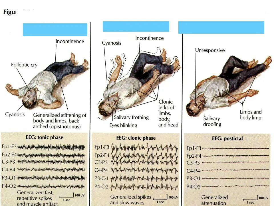 "Клоническая фаза генерализованного эпилептического припадка". Эпилепсия судорожный синдром. Фазы генерализованного судорожного припадка при эпилепсии. Клонические судороги при эпилепсии. Тонико клонические припадки