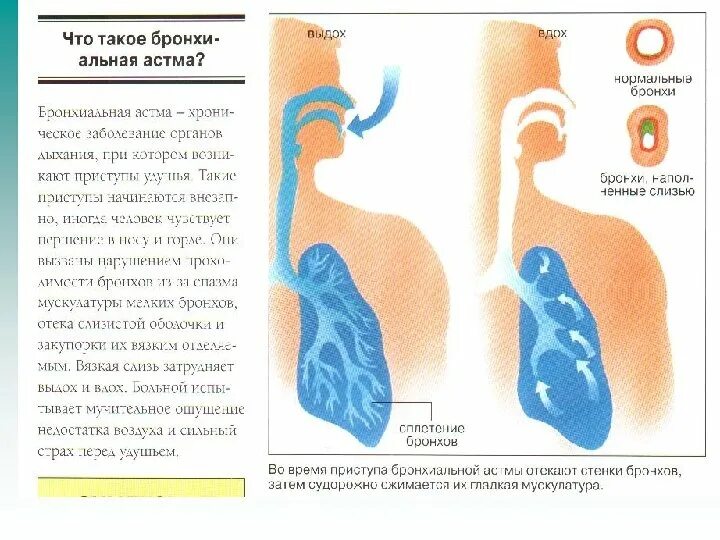 Вдох выдох выдох впр. При астме затруднен вдох. При астме затруднен выдох. При астме затруднен вдох или выдох. Астма на вдохе или выдохе.