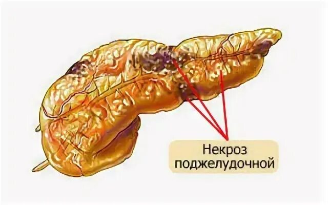 Что такое некроз поджелудочной железы у мужчин. Некротический панкреонекроз поджелудочной железы. Острый панкреатит панкреонекроз. Панкреатит некроз поджелудочной железы. Панкреонекроз поджелудочной железы патанатомия.