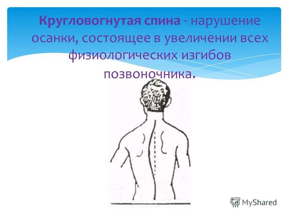 Причины вызывающие нарушения осанки. Главной причиной нарушения осанки является тест ответ. Перечислите причины нарушения осанки. Что является основной причиной нарушения осанки. Что является основной причиной нарушения осанки.