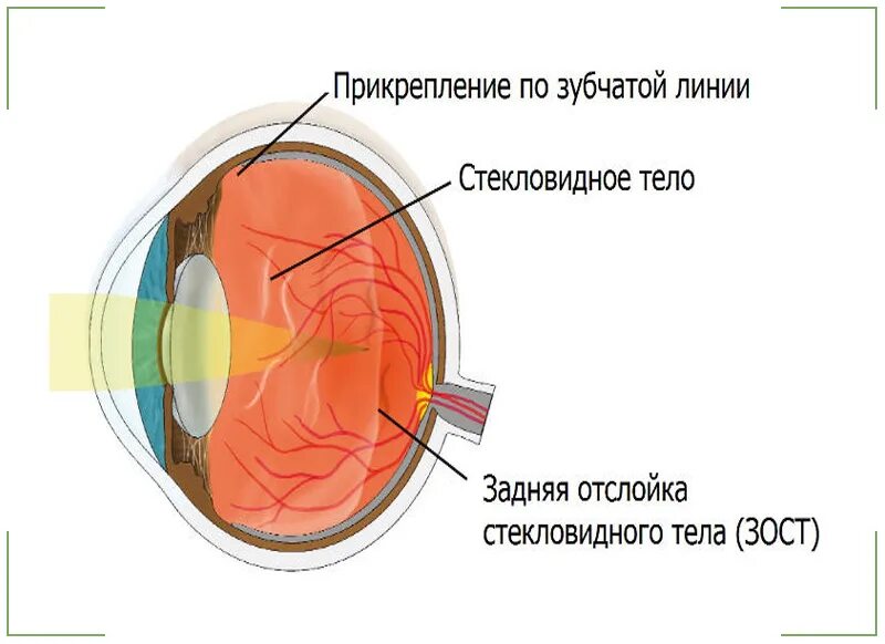 Задняя отслойка гиалоидной мембраны глаза. Частичная отслойка сетчатки. Гиалоидная мембрана стекловидного тела. Задняя отслойка сетчатки.