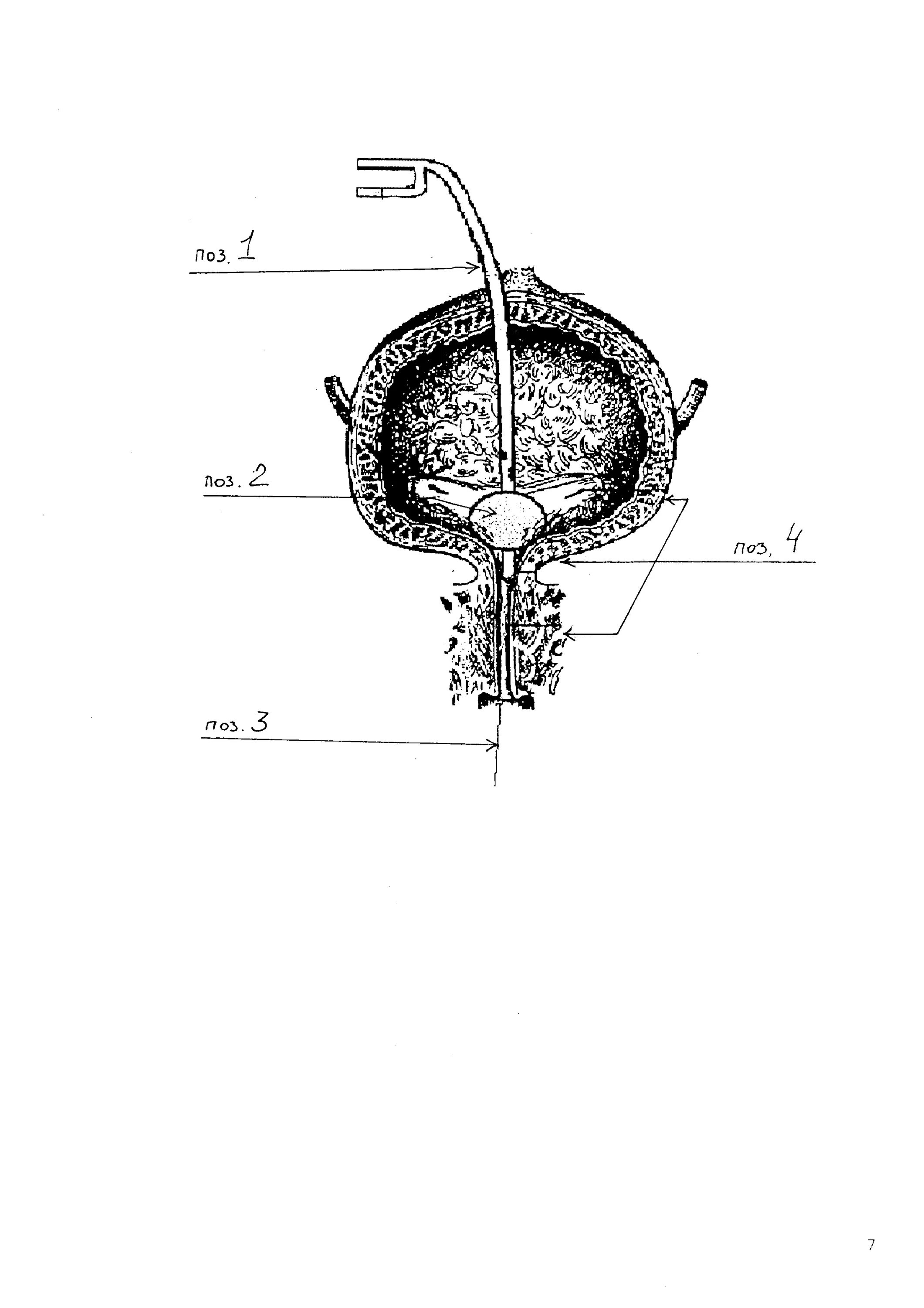 Удалили мочевой пузырь мужчине. Схема наполнения мочевого пузыря. Способы дренирования мочевого пузыря. Дренированный мочевой пузырь. Отросток в мочевом пузыре.