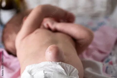 Паховая грыжа у новорожденных мальчиков