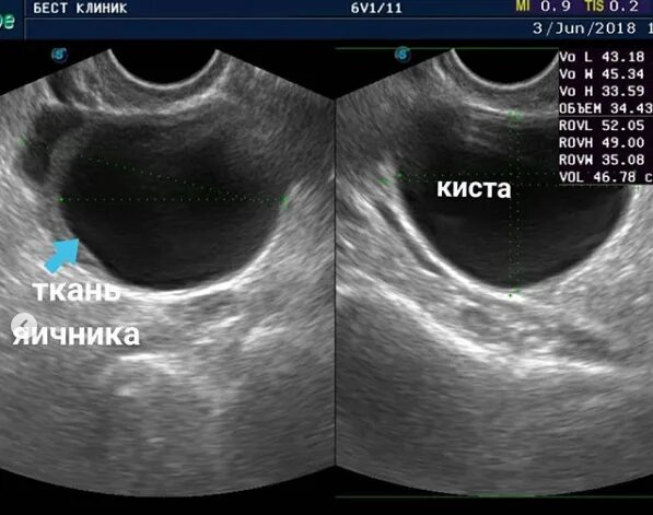 Какая норма кисты. Функциональная киста яичника на УЗИ. Фолликулярная киста яичника на УЗИ. Киста яичника на УЗИ 5см правого.