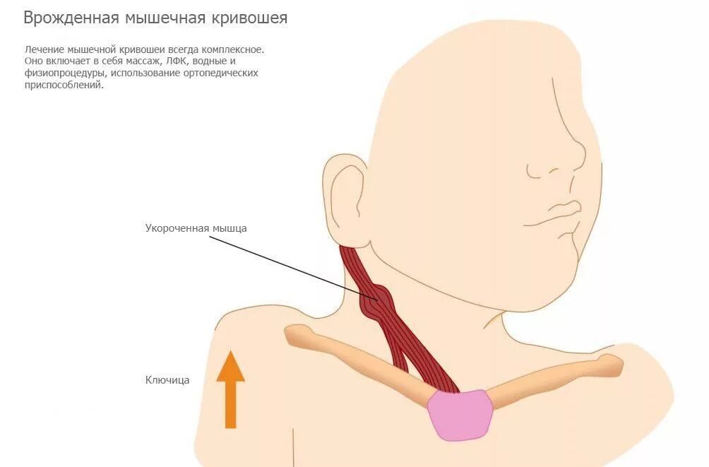 Лимфоузлы 3 месяца. Спастическая кривошея тортиколлис. Врождённая кривошея новорожденного.