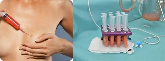 Липофилинг молочной железы. Пластика груди липофилинг. Пластика груди. Липофилинг молочной железы. Измерение женской груди.