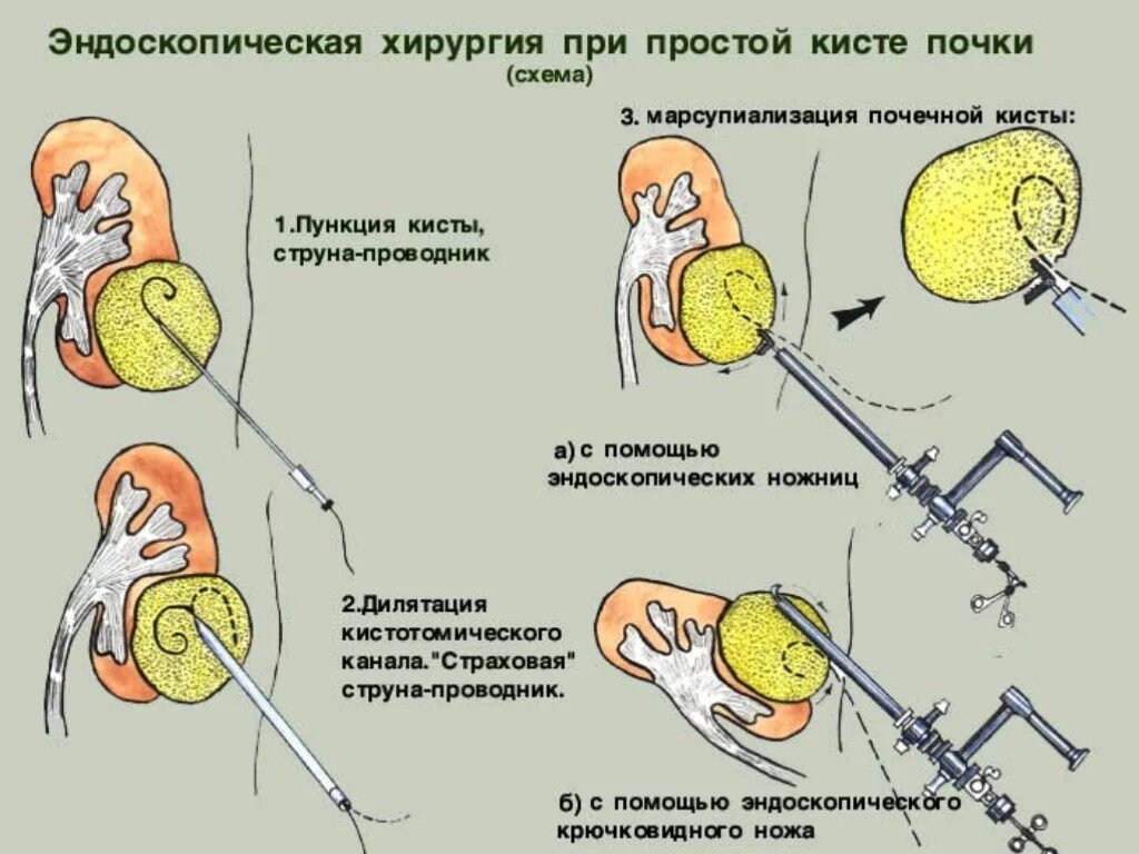 Операция пункция кисты почки. Марсупиализация кисты бартолиновой. Эндоскопическая операция почки. Операция предстательной железы отзывы