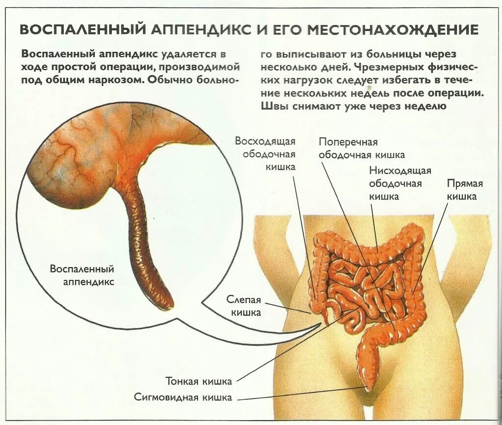 Аппендицит после 40 лет у мужчин. Воспаленный аппендикс. Расположение аппендицита. Место расположения аппендикса.