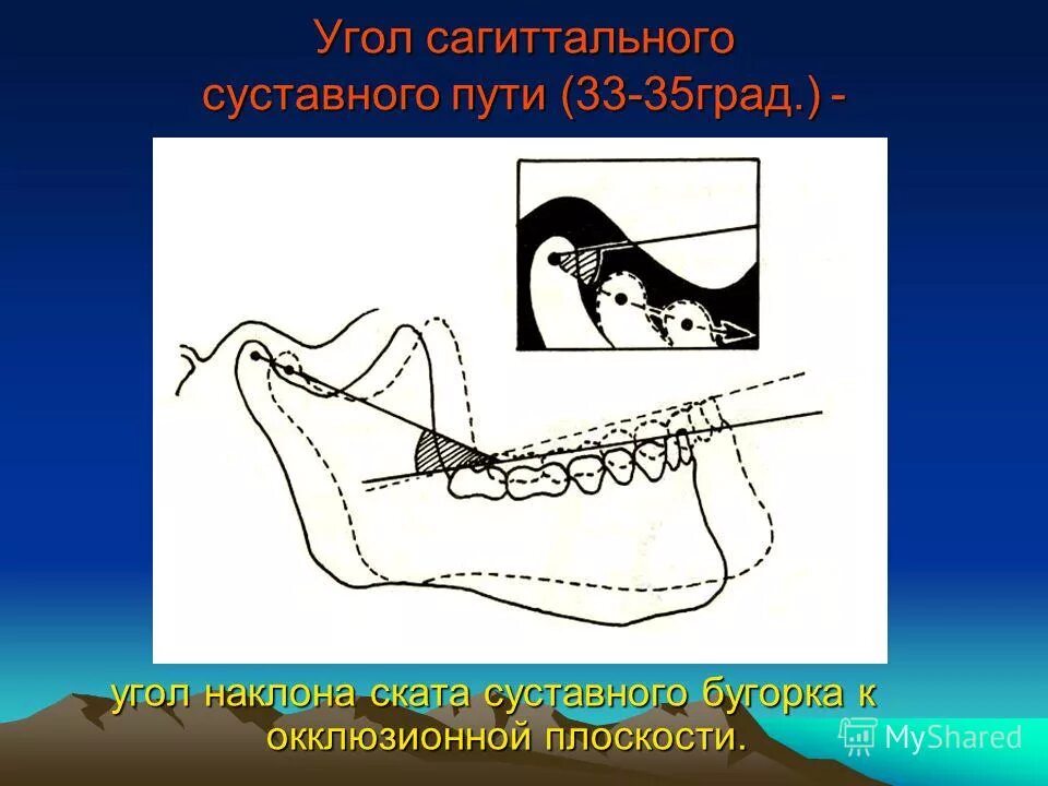 Угол путь. Угол сагиттального резцового пути. резцовый путь движения нижней челюсти. сагиттальный суставной путь. угол сагиттального суставного и резцового пути.