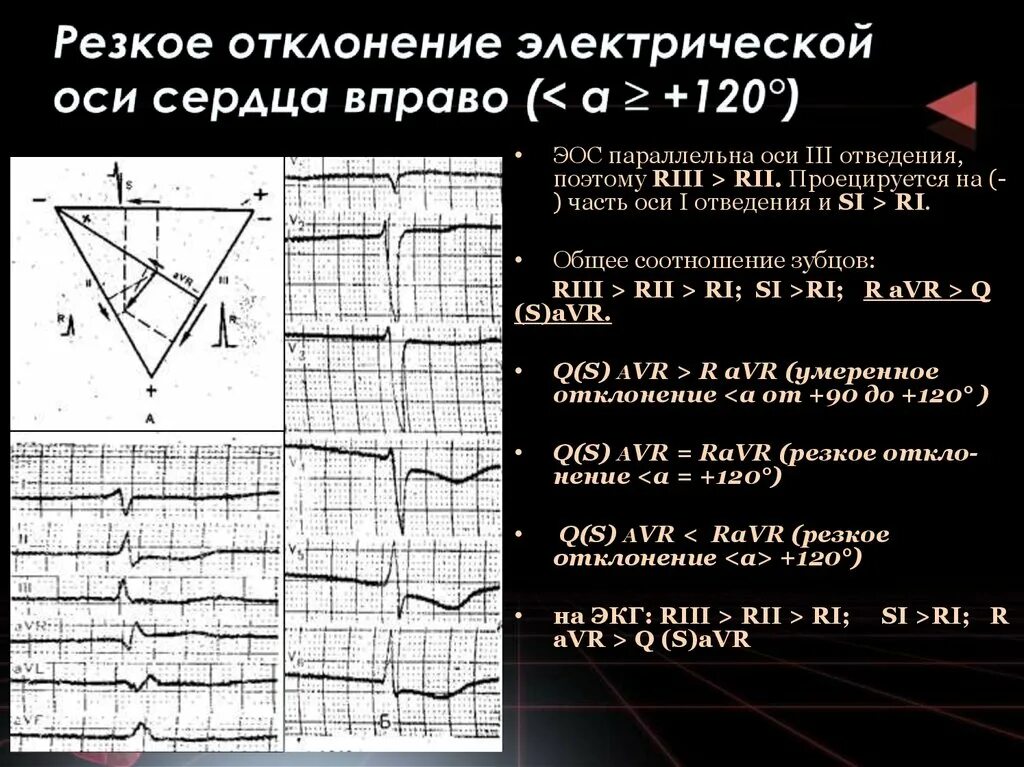 Сердце отклонено вправо. Отклонение ЭОС вправо на ЭКГ. Отклонение оси вправо на ЭКГ. Отклонение электрической оси вправо на ЭКГ. Отклонение электрической оси влево на ЭКГ.