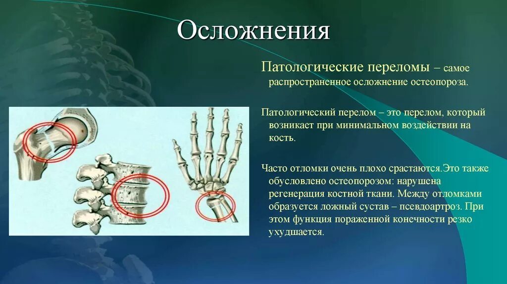 Осложнения возникающие при переломах. Осложнения при остеопорозе. осложнения остеопороза. профилактика осложнений остеопороза. химические основы остеопороза.