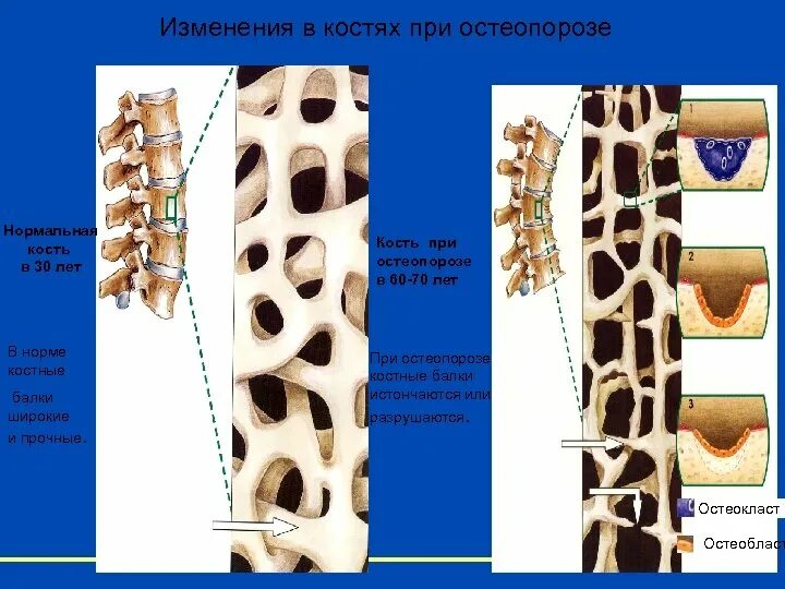 Остеопороз патологическая анатомия. Нормальная кость и остеопороз. Нормальная кость и кость при остеопорозе. В костях и т д