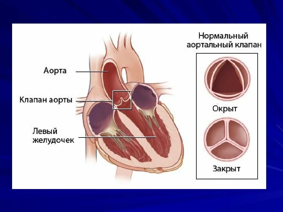Впс двустворчатый аортальный клапан. Двухстворчатый аортальный клапан тип 2. створки аортального клапана анатомия. клапан сердца порок двухстворчатый аортальный клапан. врожденный двустворчатый аортальный клапан.
