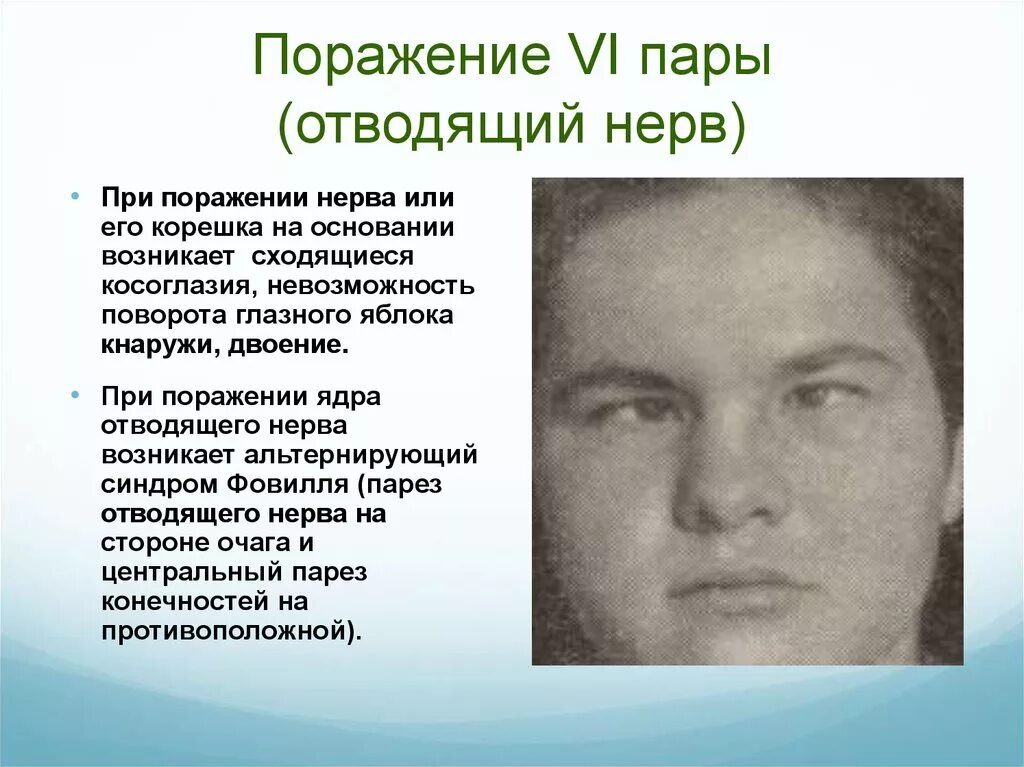 Парез латынь. Поражение 6 Черепного нерва. Отводящий нерв симптомы и синдромы поражения. Симптомы поражения отводящего нерва. Симптомы периферического поражения отводящего нерва.