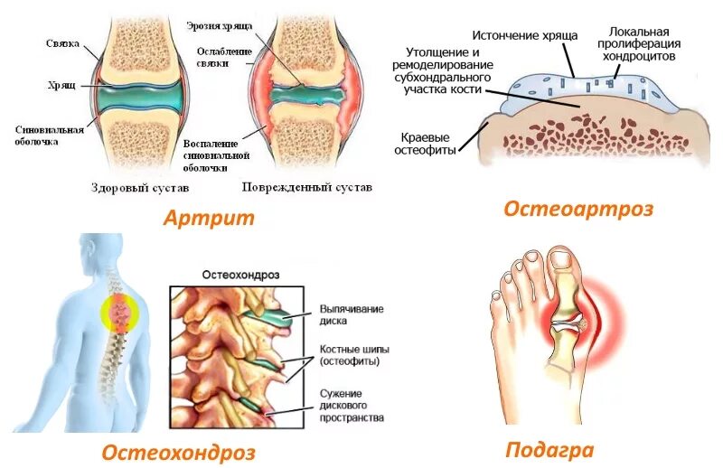 Артрит и артроз разница. Отличия артроз артрит остеохондроз. Артрит артроз остеопороз. Остеохондроз остеоартроз артрит разница. Остеохондроз остеопороз остеоартроз разница.