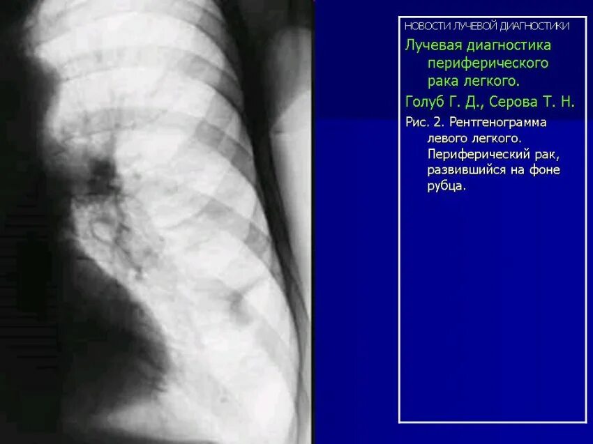 Признаки периферического легкого. Рентгенодиагностика легких. Опухоль с распадом на рентгене. Периферический ра легкого рентег. Лучевая диагностика объемных образований легких.