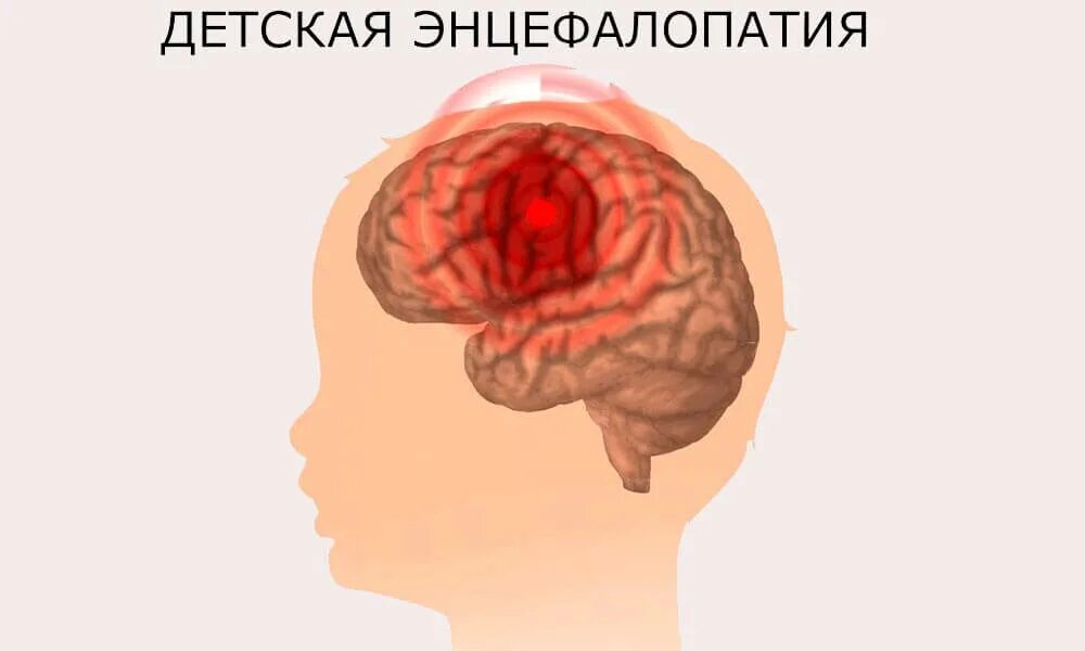 Энцефалопатия что это такое. Черепно мозговая энцефалопатия. Энцелофапатия головного мозга у детей. Энцефалопатия головного мозга что это такое у ребенка. Энцефалодисплазия головного мозга у детей.