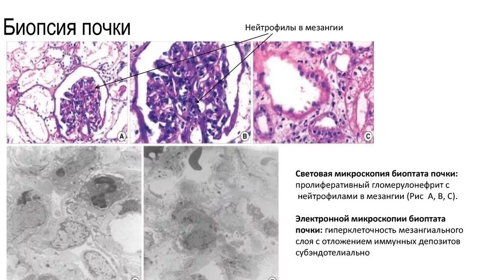 Как делают биопсию почки