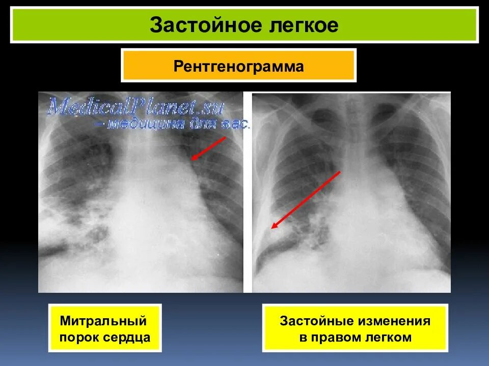 Застойные изменения в легких