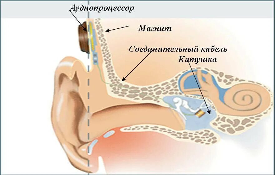 Отосклероз уха операция. Отосклероз слуховой аппарат. Имплантируемые слуховые аппараты среднего уха. Имплантанты среднего уха.