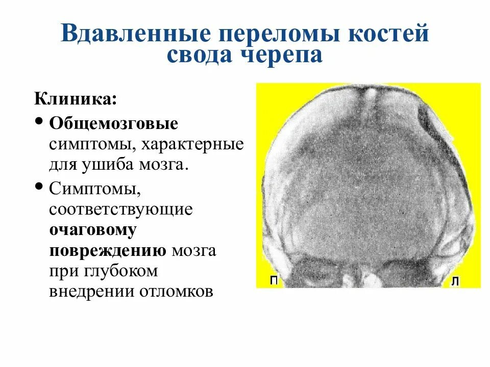 Травма мозга очаговая. Переломы костей черепа клиника. Перелом свода черепа клиника. Перелом основания черепа клиника. Вдавленный перелом свода черепа.