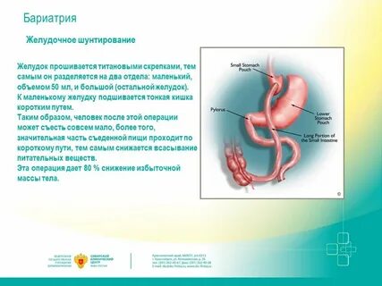 Желудок после бариатрической операции