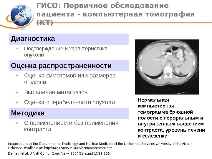 Гастроинтестинальная стромальная опухоль желудка на кт. Гастроинтестинальная опухоль