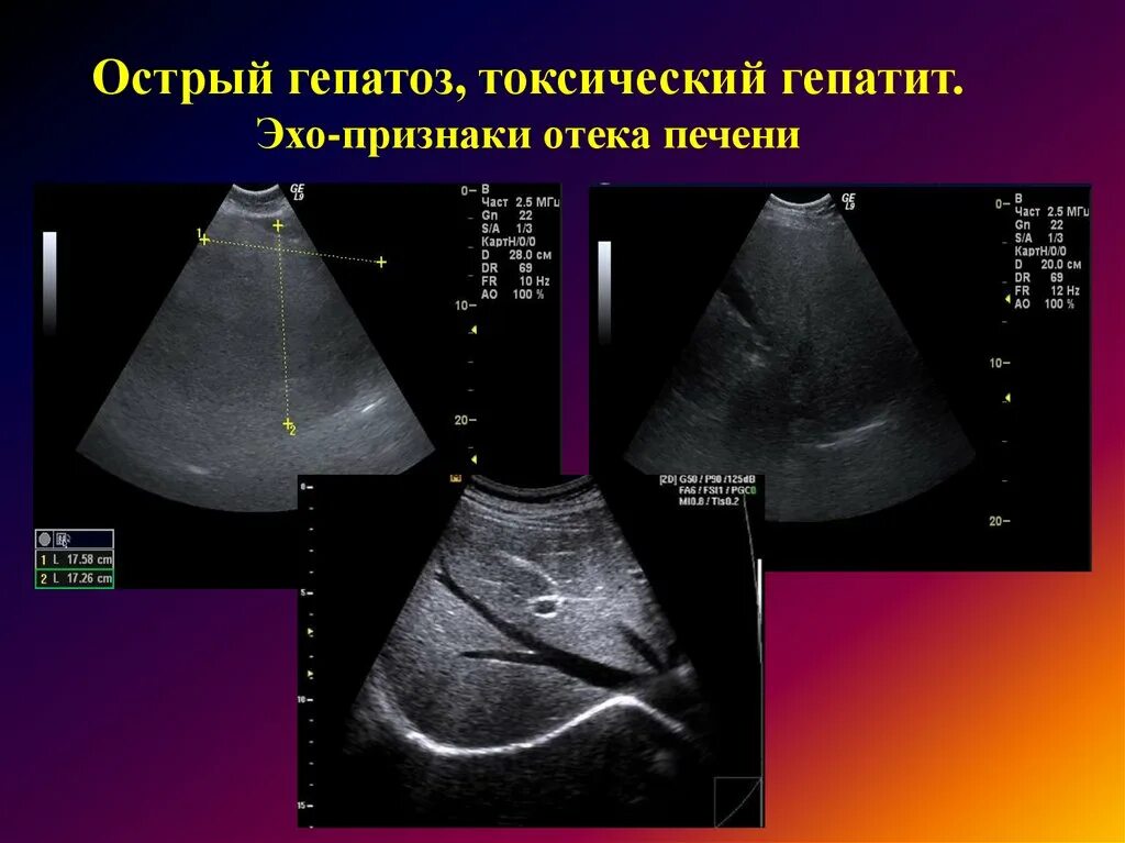 Токсический печени симптомы. Острый гепатит на УЗИ признаки. Очаговая форма жирового гепатоза УЗИ. Токсическое поражение печени на УЗИ. Токсический гепатит на УЗИ.