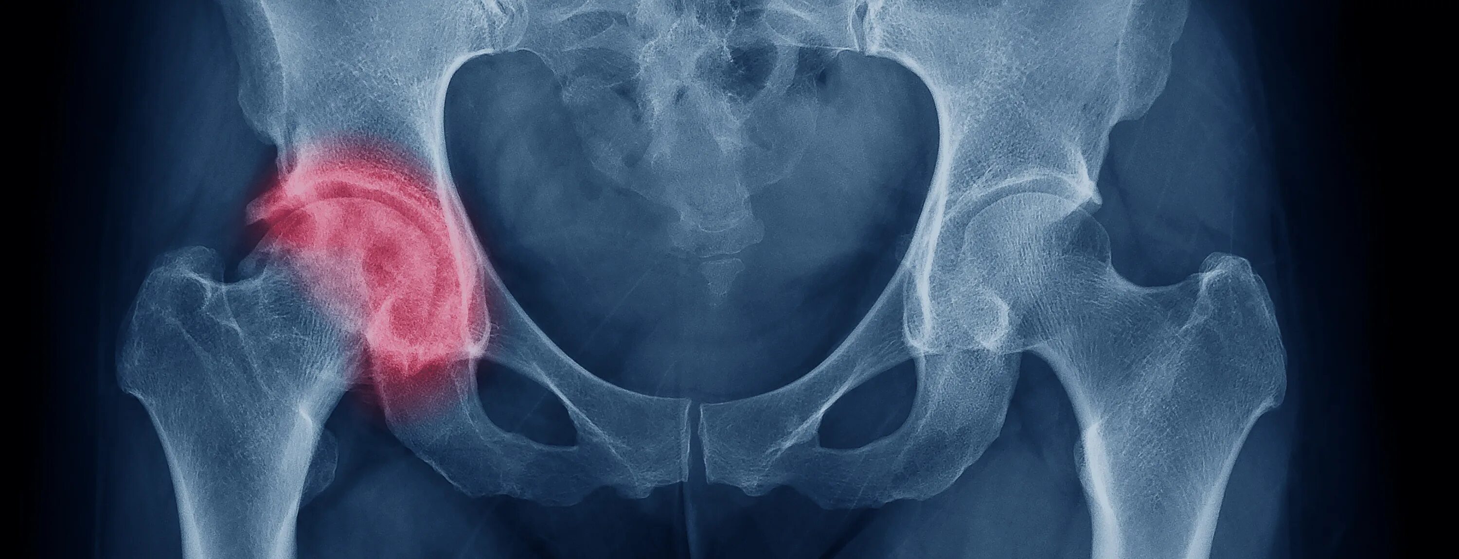 Вколоченный перелом шейки бедра рентген. Лигаментоз тазобедренного сустава рентген. Остеопороз тазобедренного сустава. Вколоченный перелом шейки бедра. Врач шейка бедра