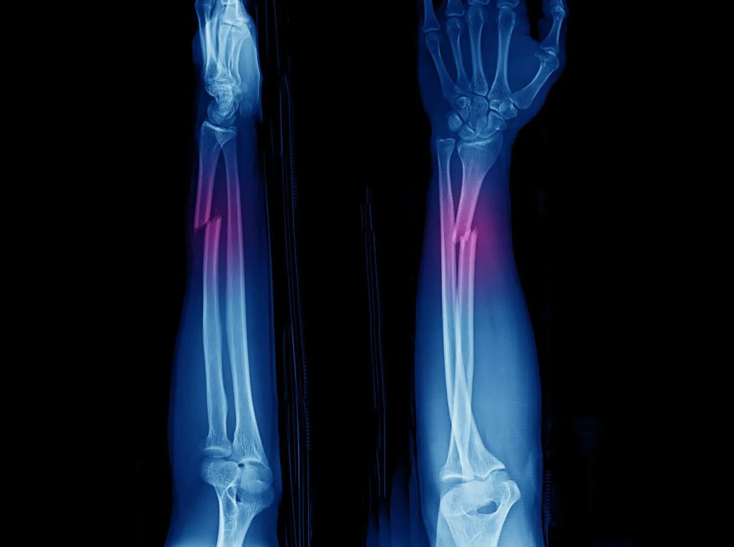 Fracture c