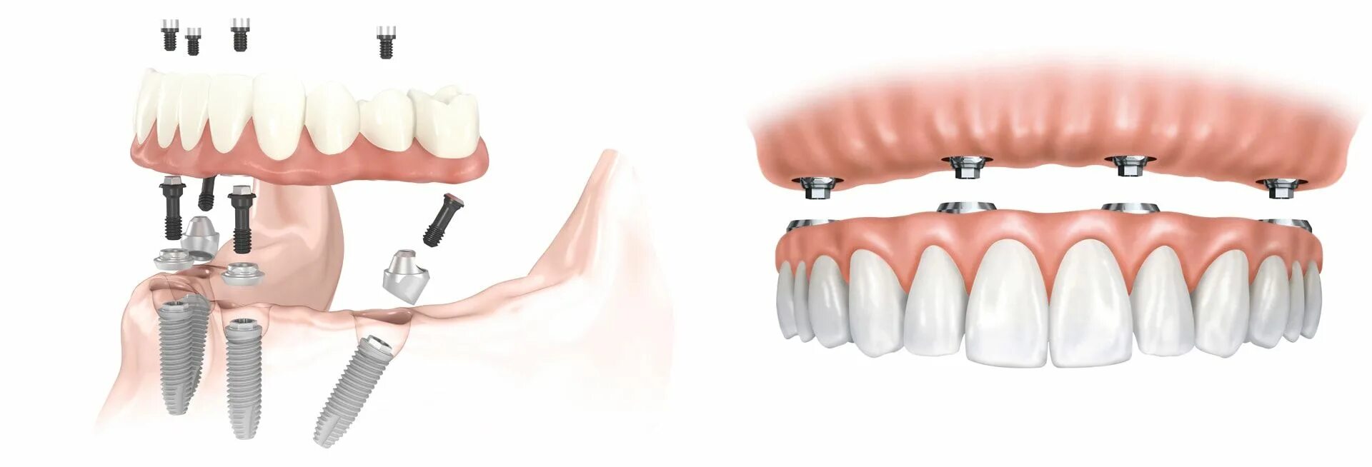 Аллон 4 протезирование. Имплантация зубов all on 4. Имплантация all-on-4 ( всё на 4х). (Метод имплантации all-on-4)методы.