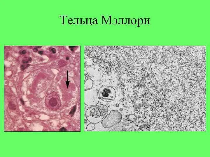 Тельца мэллори. Алкогольный гиалин тельца мэллори. тельца маллори патанатомия. тельца мэллори гистология. гиалиново капельная дистрофия патанатомия.