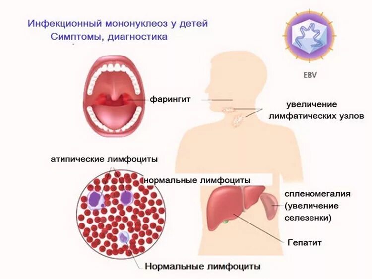 Мононуклеоз это. Инфекционный мононуклеоз симптомы. Инфекционный мононуклеоз у детей 10 месяцев. Герпетическая инфекция Эпштейн-Барра. Неосложненный инфекционный мононуклеоз.