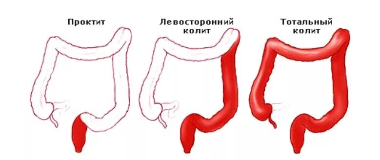 Тотальный язвенный колит. Неспецифический язвенный колит проктит. Эритематозный проктит. Язвенный проктит прямой кишки. Лечение проктита прямой