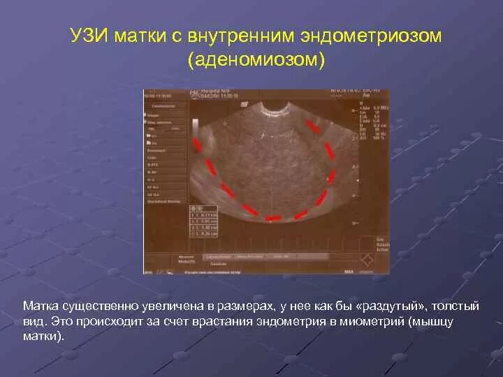 УЗИ критерии внутреннего эндометриоза. Внутренний эндометриоз на УЗИ.