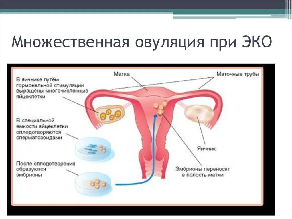 Можно забеременеть при непроходимости труб. Перенос эмбрионов в полость матки. Беременность без труб естественным путем. Беременность без маточных труб.