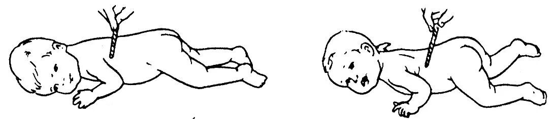 Спинальный рефлекс галанта. Рефлекс галанта у грудничка. Рефлекс переса у новорожденных. Патологические рефлексы симптом бабинского. Рефлекс переса у новорожденных.