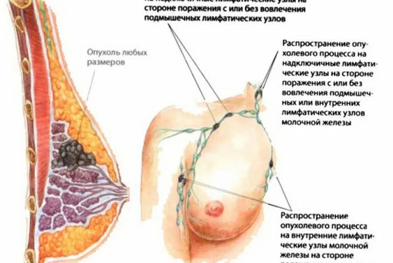 Лимфоузлы при рмж. Злокачественное новообразование молочной железы. Лимфоузлы млоочно йжелезхы. Внутренние лимфатические узлы молочной железы. Опухолевые процессы в груди.